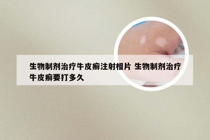生物制剂治疗牛皮癣注射相片 生物制剂治疗牛皮癣要打多久