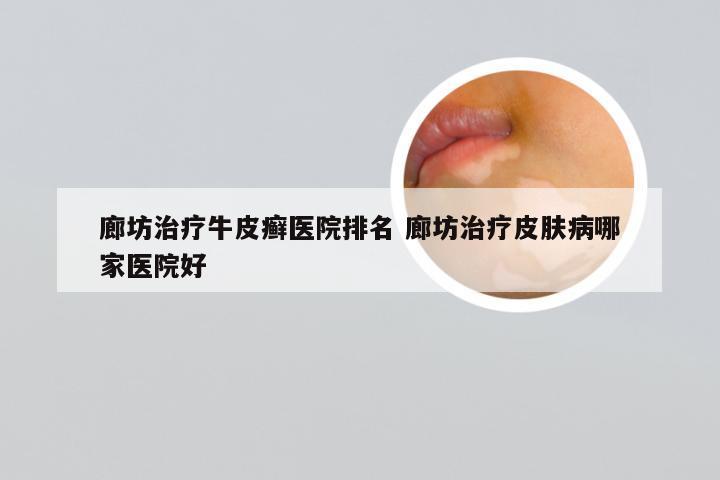 廊坊治疗牛皮癣医院排名 廊坊治疗皮肤病哪家医院好