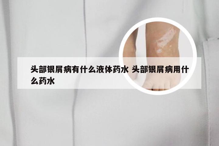 头部银屑病有什么液体药水 头部银屑病用什么药水