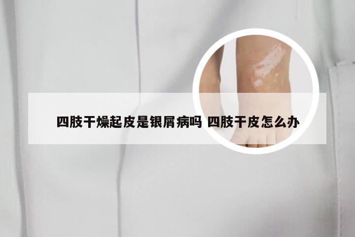 四肢干燥起皮是银屑病吗 四肢干皮怎么办