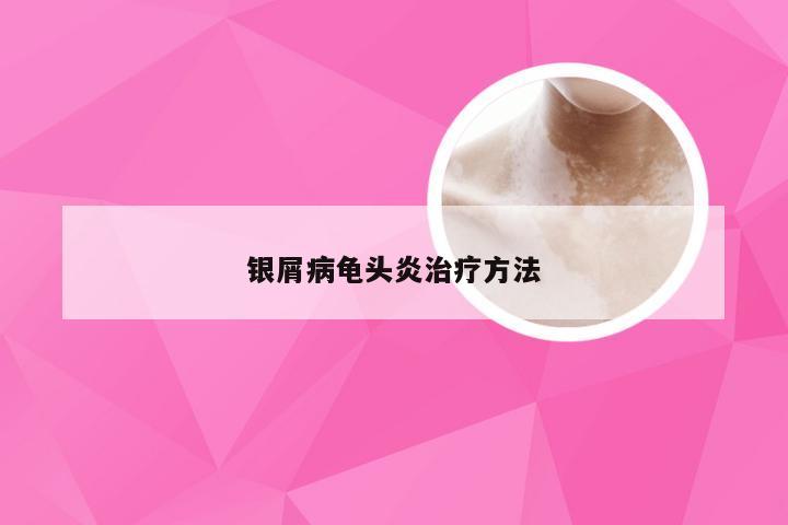 银屑病龟头炎治疗方法
