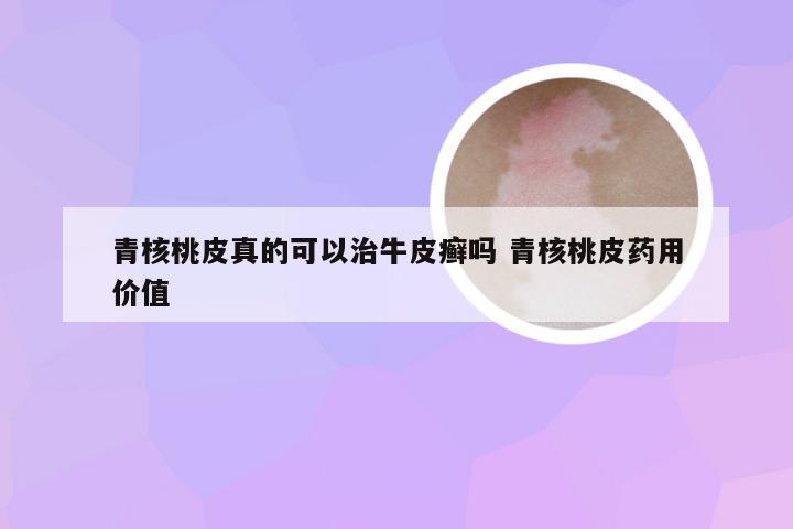 青核桃皮真的可以治牛皮癣吗 青核桃皮药用价值