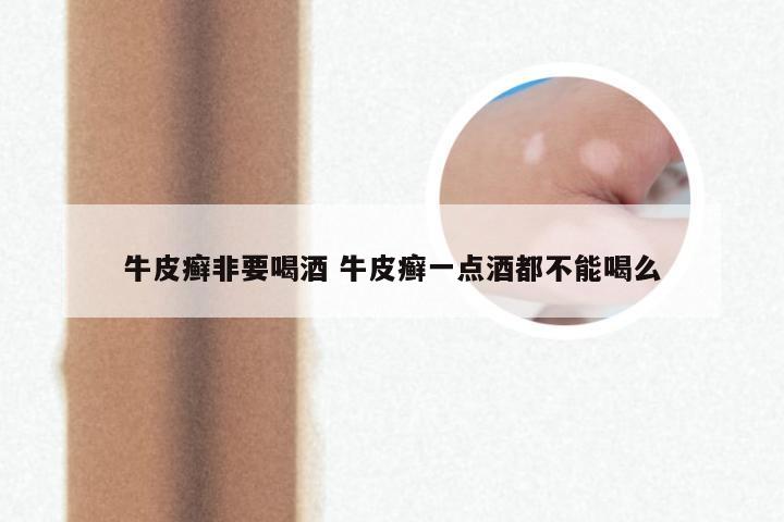 牛皮癣非要喝酒 牛皮癣一点酒都不能喝么