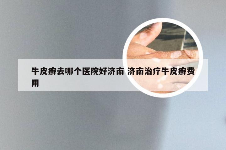 牛皮癣去哪个医院好济南 济南治疗牛皮癣费用