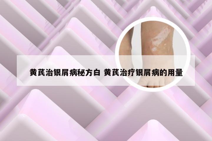 黄芪治银屑病秘方白 黄芪治疗银屑病的用量