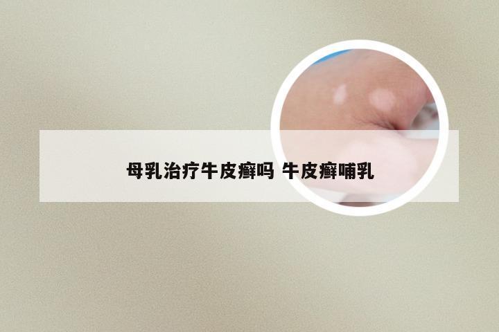 母乳治疗牛皮癣吗 牛皮癣哺乳