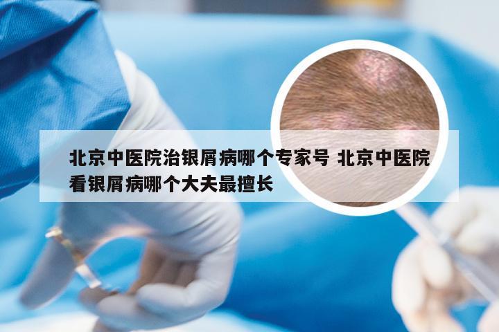 北京中医院治银屑病哪个专家号 北京中医院看银屑病哪个大夫最擅长