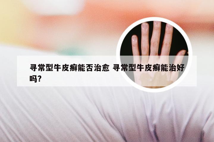 寻常型牛皮癣能否治愈 寻常型牛皮癣能治好吗?