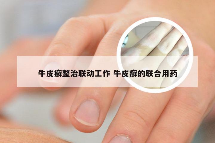 牛皮癣整治联动工作 牛皮癣的联合用药
