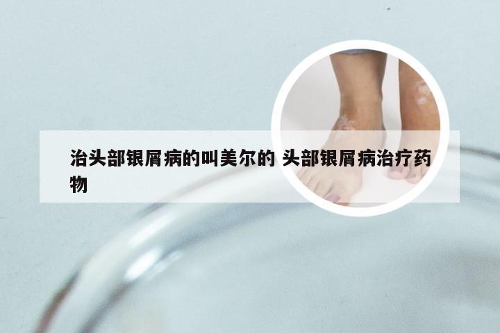 治头部银屑病的叫美尔的 头部银屑病治疗药物
