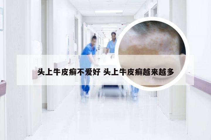 头上牛皮癣不爱好 头上牛皮癣越来越多