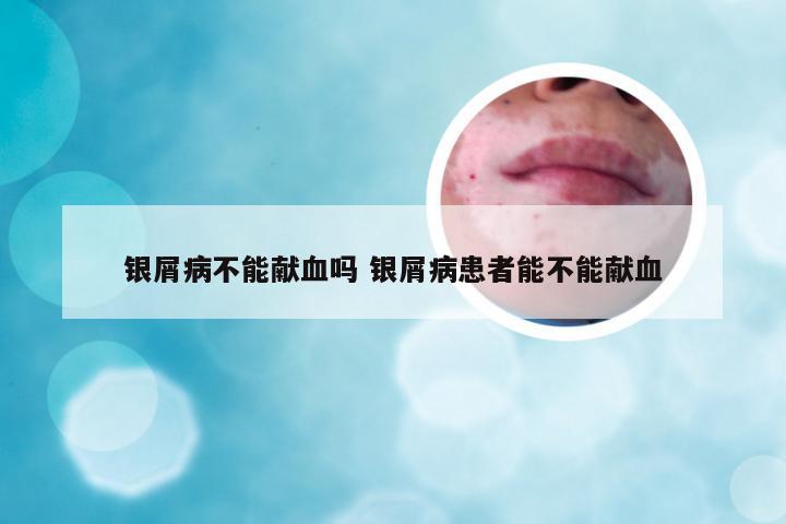 银屑病不能献血吗 银屑病患者能不能献血