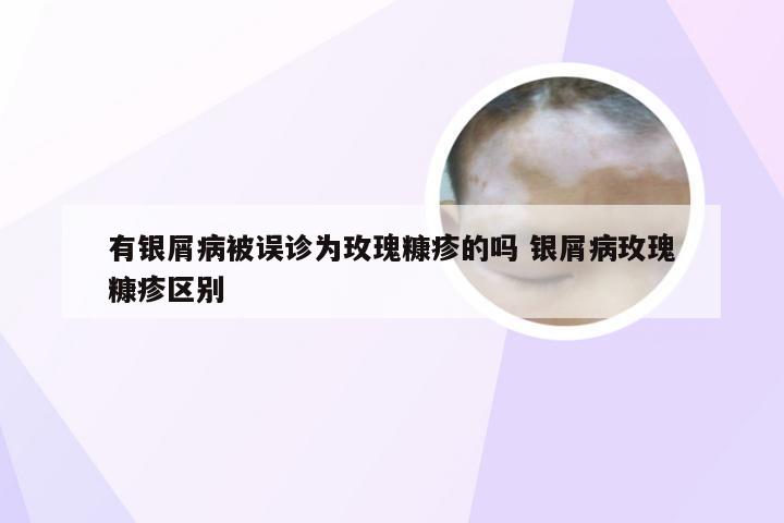 有银屑病被误诊为玫瑰糠疹的吗 银屑病玫瑰糠疹区别