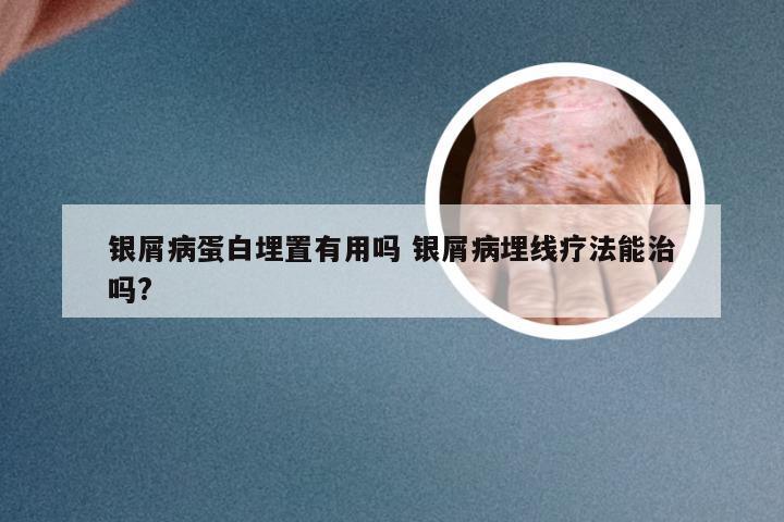 银屑病蛋白埋置有用吗 银屑病埋线疗法能治吗?