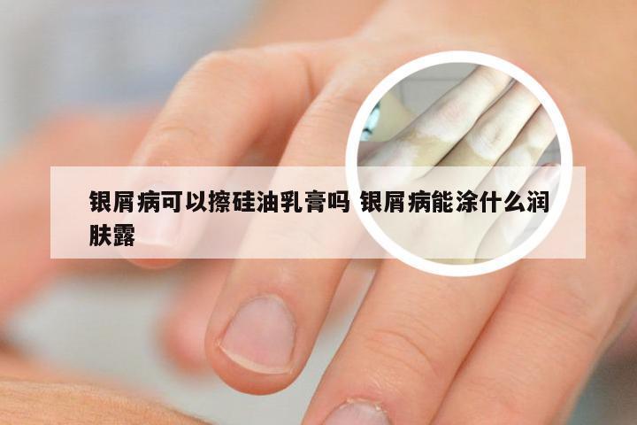 银屑病可以擦硅油乳膏吗 银屑病能涂什么润肤露