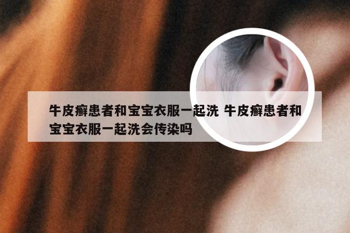 牛皮癣患者和宝宝衣服一起洗 牛皮癣患者和宝宝衣服一起洗会传染吗