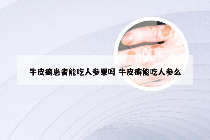 牛皮癣患者能吃人参果吗 牛皮癣能吃人参么