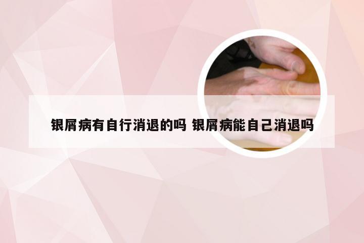 银屑病有自行消退的吗 银屑病能自己消退吗