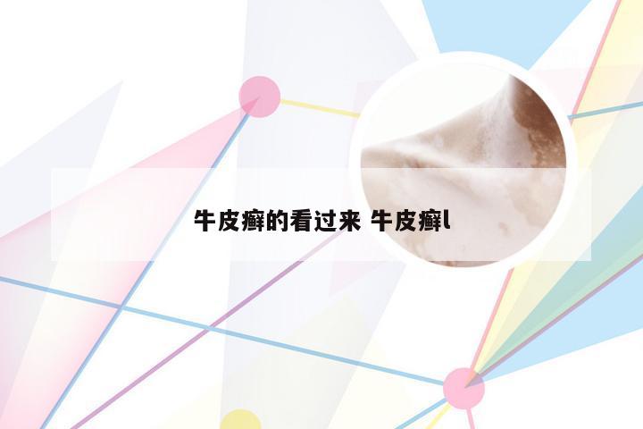 牛皮癣的看过来 牛皮癣l