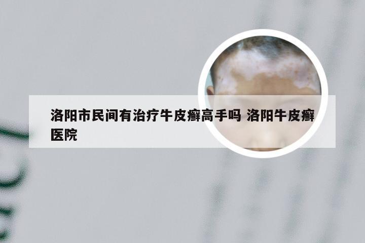 洛阳市民间有治疗牛皮癣高手吗 洛阳牛皮癣医院
