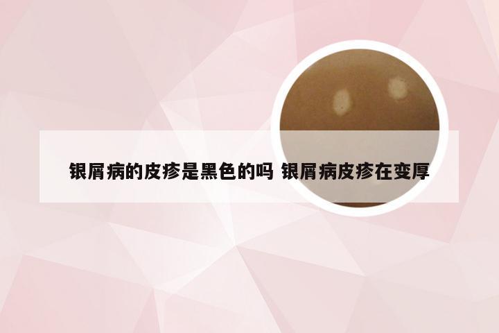 银屑病的皮疹是黑色的吗 银屑病皮疹在变厚