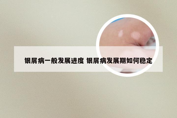 银屑病一般发展进度 银屑病发展期如何稳定