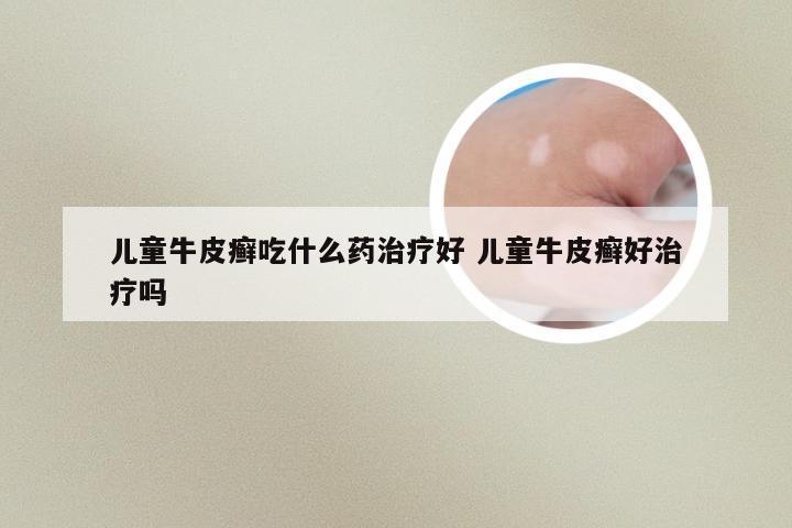 儿童牛皮癣吃什么药治疗好 儿童牛皮癣好治疗吗