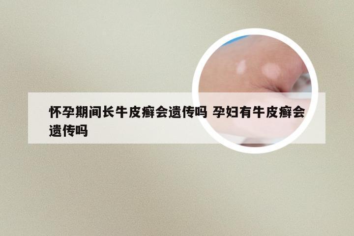 怀孕期间长牛皮癣会遗传吗 孕妇有牛皮癣会遗传吗