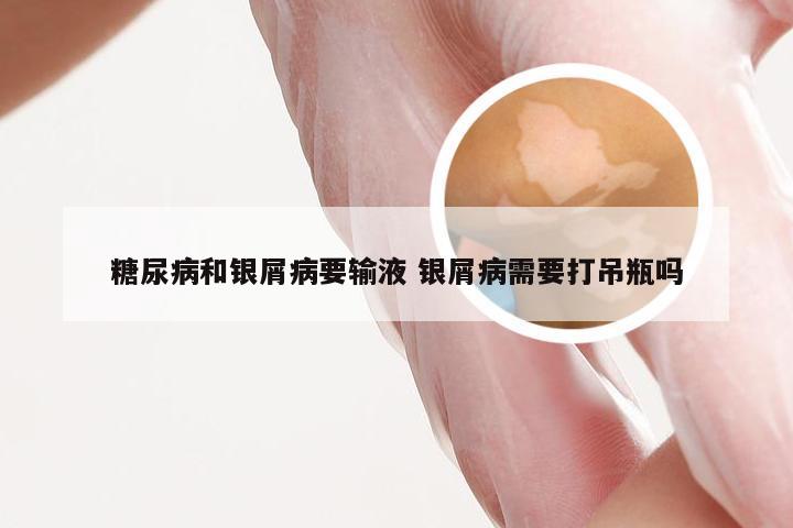 糖尿病和银屑病要输液 银屑病需要打吊瓶吗
