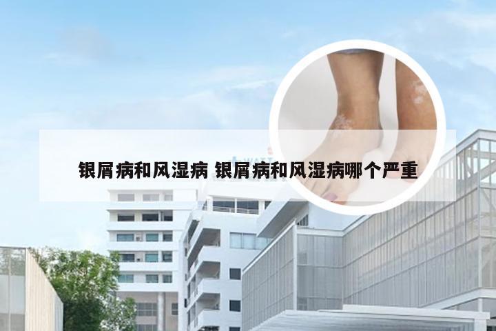 银屑病和风湿病 银屑病和风湿病哪个严重