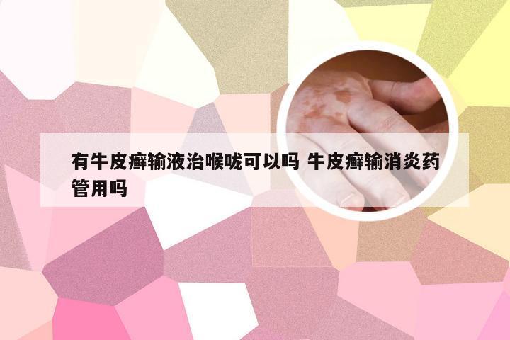 有牛皮癣输液治喉咙可以吗 牛皮癣输消炎药管用吗
