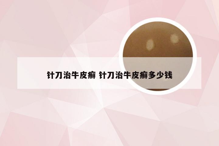 针刀治牛皮癣 针刀治牛皮癣多少钱