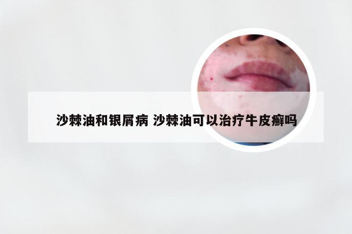 沙棘油和银屑病 沙棘油可以治疗牛皮癣吗