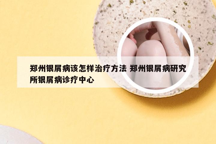 郑州银屑病该怎样治疗方法 郑州银屑病研究所银屑病诊疗中心