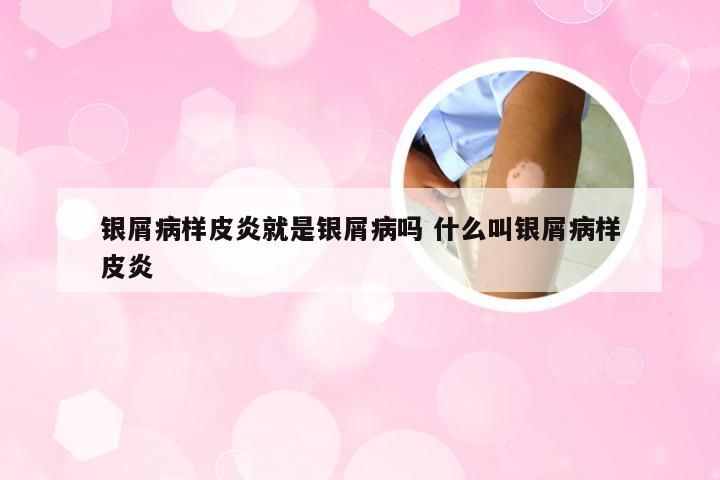 银屑病样皮炎就是银屑病吗 什么叫银屑病样皮炎