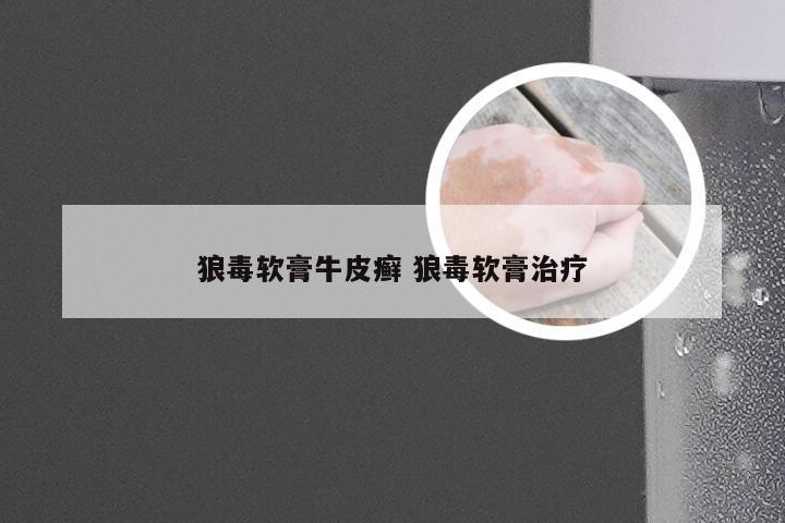 狼毒软膏牛皮癣 狼毒软膏治疗