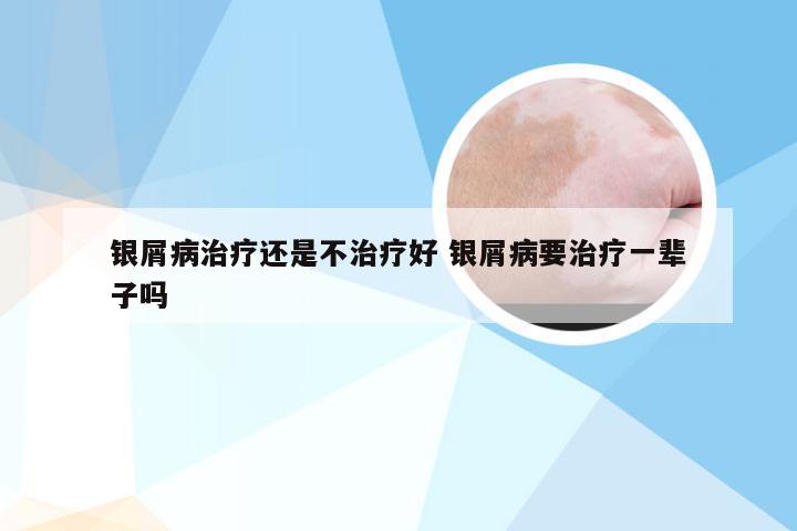 银屑病治疗还是不治疗好 银屑病要治疗一辈子吗