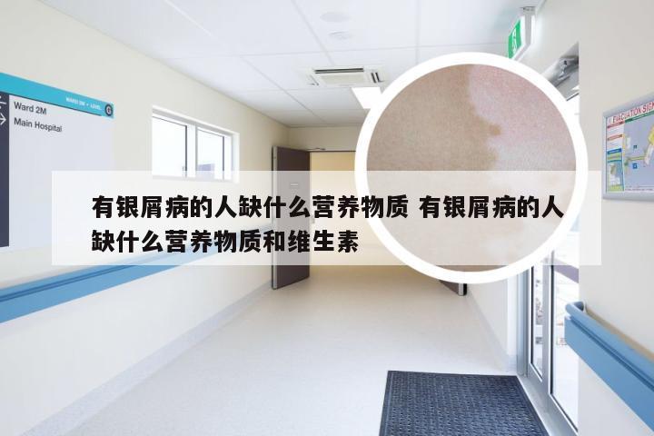 有银屑病的人缺什么营养物质 有银屑病的人缺什么营养物质和维生素