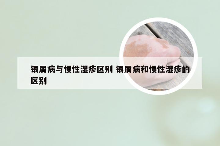 银屑病与慢性湿疹区别 银屑病和慢性湿疹的区别