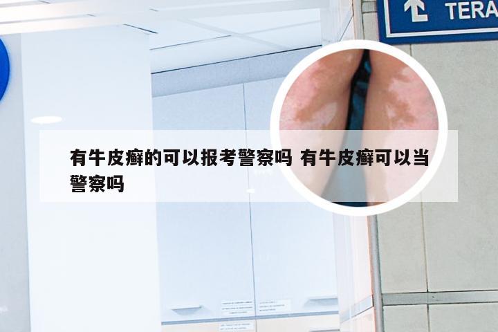有牛皮癣的可以报考警察吗 有牛皮癣可以当警察吗