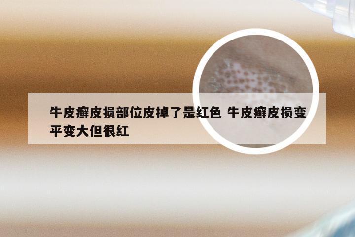 牛皮癣皮损部位皮掉了是红色 牛皮癣皮损变平变大但很红