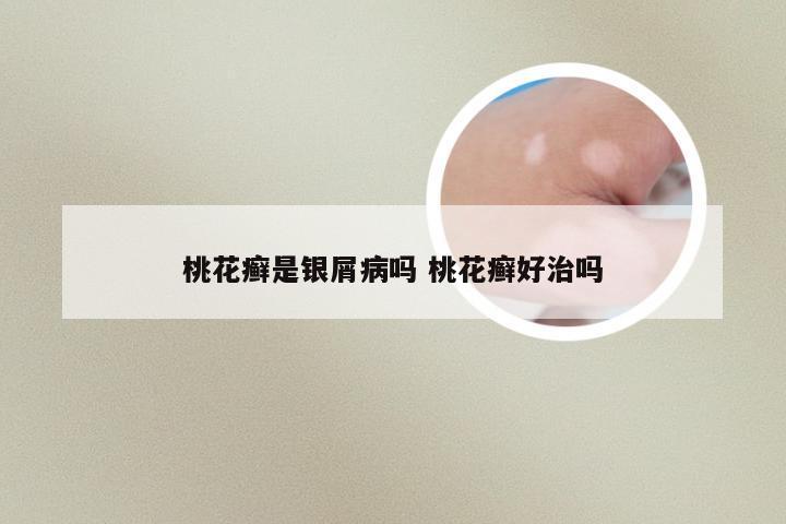 桃花癣是银屑病吗 桃花癣好治吗