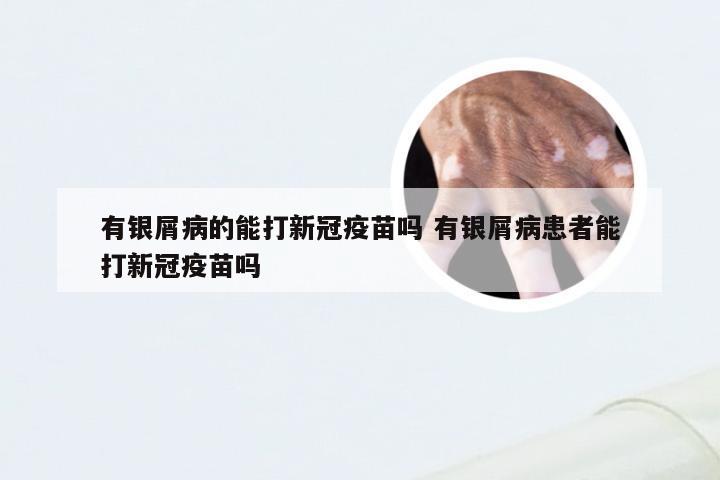 有银屑病的能打新冠疫苗吗 有银屑病患者能打新冠疫苗吗