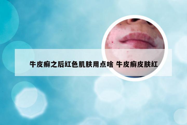 牛皮癣之后红色肌肤用点啥 牛皮癣皮肤红