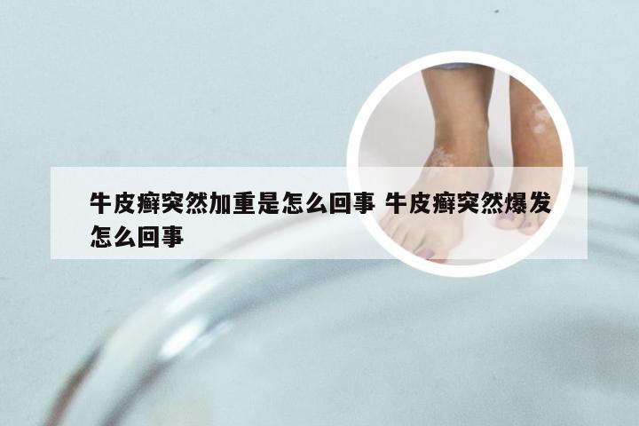 牛皮癣突然加重是怎么回事 牛皮癣突然爆发怎么回事