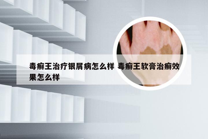 毒癣王治疗银屑病怎么样 毒癣王软膏治癣效果怎么样