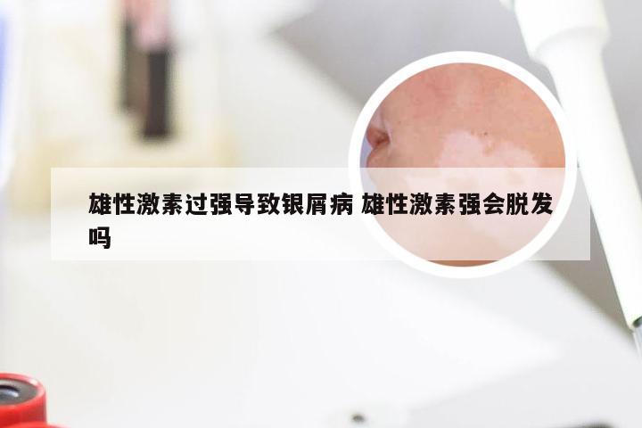 雄性激素过强导致银屑病 雄性激素强会脱发吗