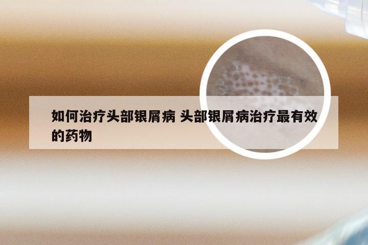 如何治疗头部银屑病 头部银屑病治疗最有效的药物