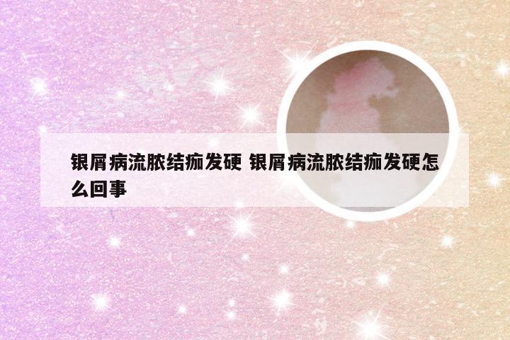 银屑病流脓结痂发硬 银屑病流脓结痂发硬怎么回事