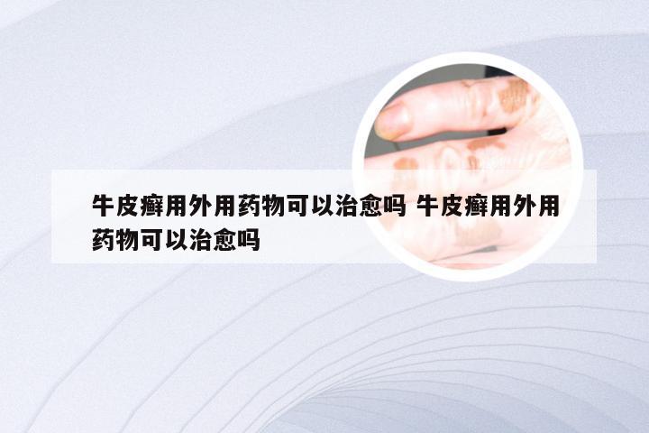 牛皮癣用外用药物可以治愈吗 牛皮癣用外用药物可以治愈吗